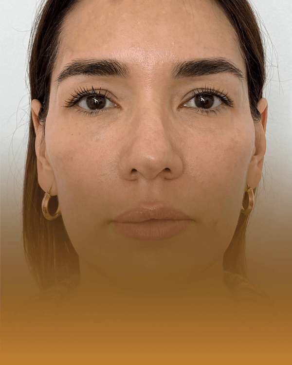 SCULPTRA