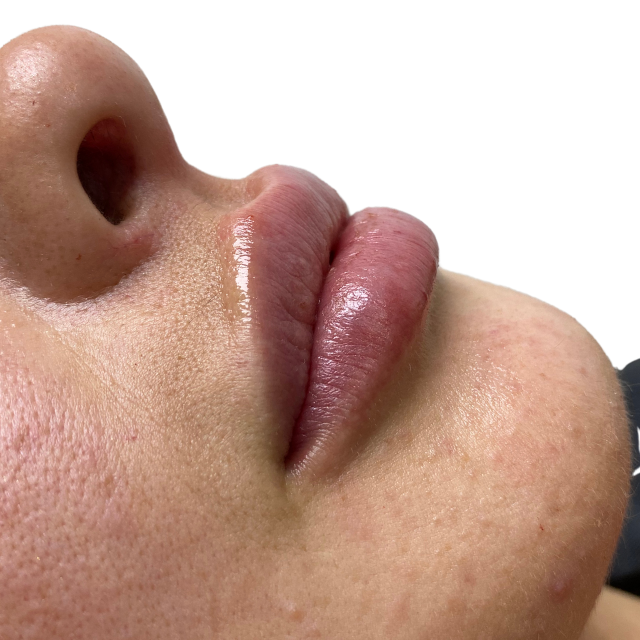 After-Aumento de Labios