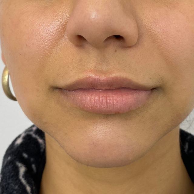 Before-Labios