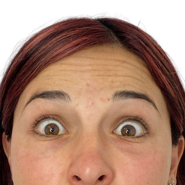 Before-Botox