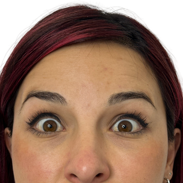 After-Botox