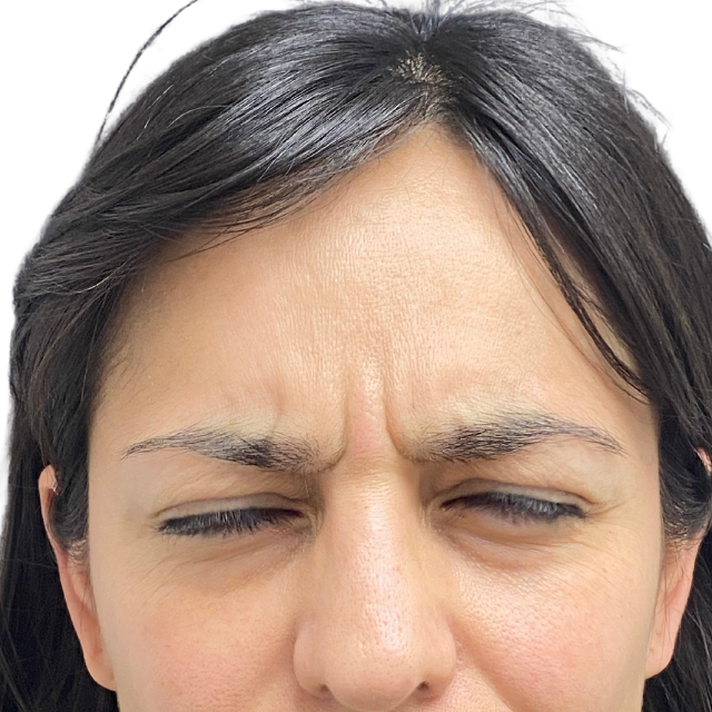 Before-Botox