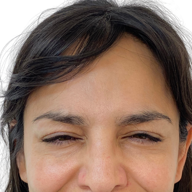 After-Botox